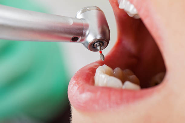 Best Emergency Root Canal Treatment in Edgefield, SC